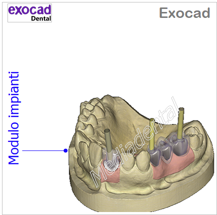Exocad - immagine 4